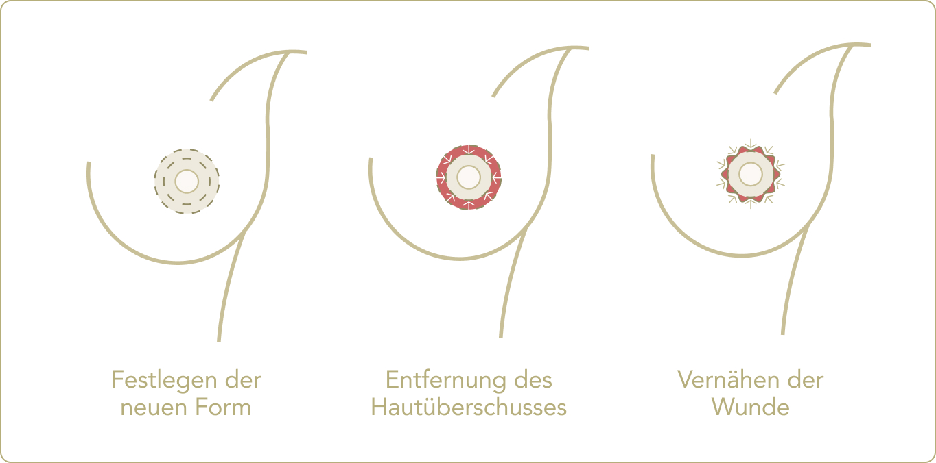 Brustwarzenkorrektur - Wie ist der Ablauf einer Korrektur des Brustwarzenvorhofs?