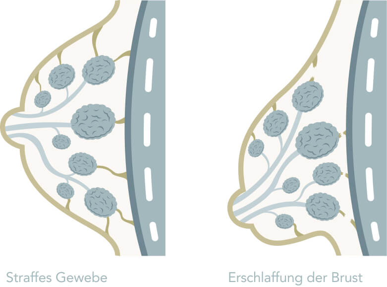 Hängebrust - Erschlaffung