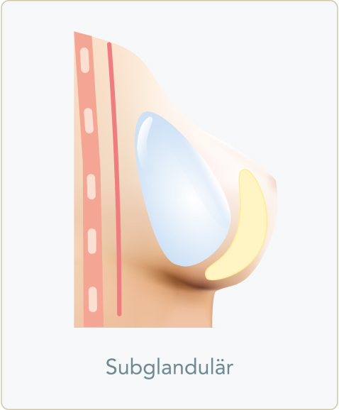 Implantate, Schnitttechnik und Implantatplatzierung! - Subglandulär