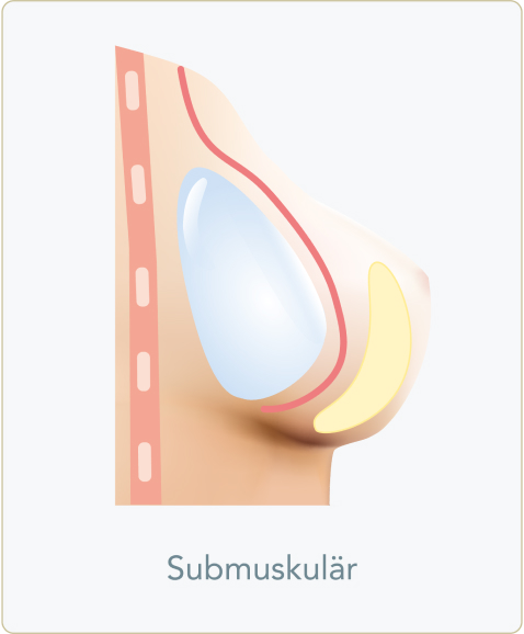 Implantate, Schnitttechnik und Implantatplatzierung! - Subpektoral (Submuskulär)