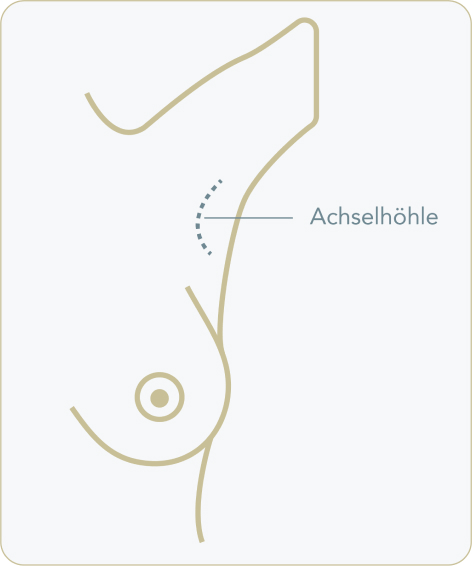 Implantate, Schnitttechnik und Implantatplatzierung! - Schnitt in der Achselhöhle (Transaxillär)