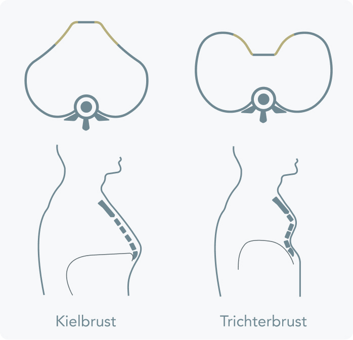 Kielbrust - Was versteht die Medizin unter einer Kielbrust?