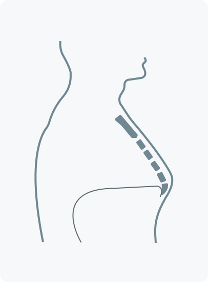 Kielbrust - Was versteht die Medizin unter einer Kielbrust?