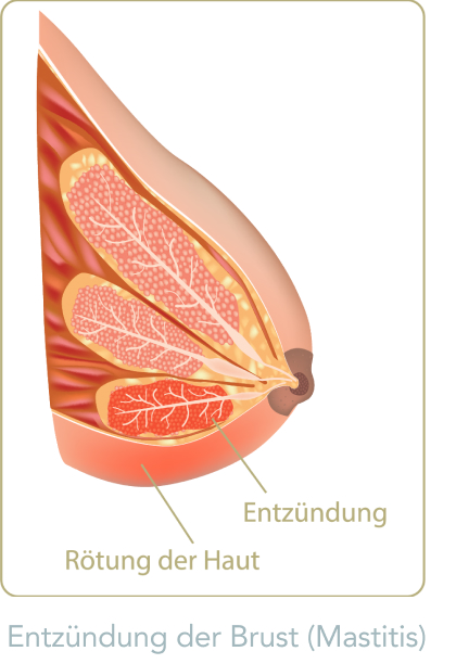 Mammographie - Welche gutartigen Veränderungen können in der Brust auftreten?