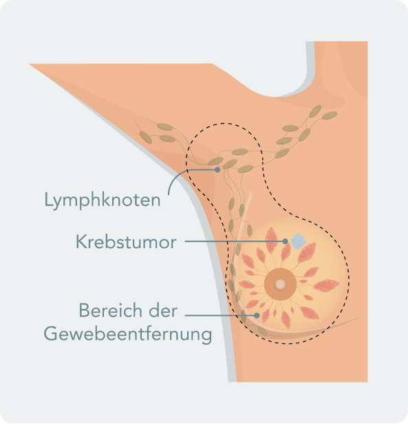 Mastektomie - Welche Formen der Mastektomie gibt es?