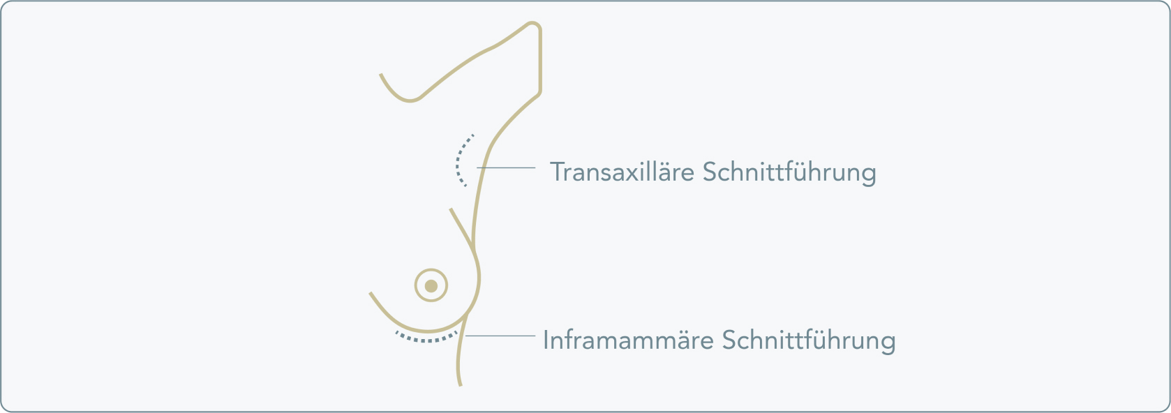 Periareolärer Zugang - transaxilläre Zugangs