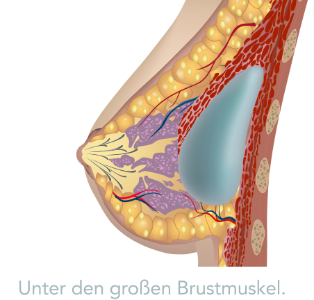 Periareolärer Zugang - Was versteht die Medizin unter einem periareolären Zugang?