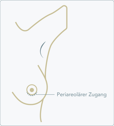 Periareolärer Zugang - Was versteht die Medizin unter einem periareolären Zugang?