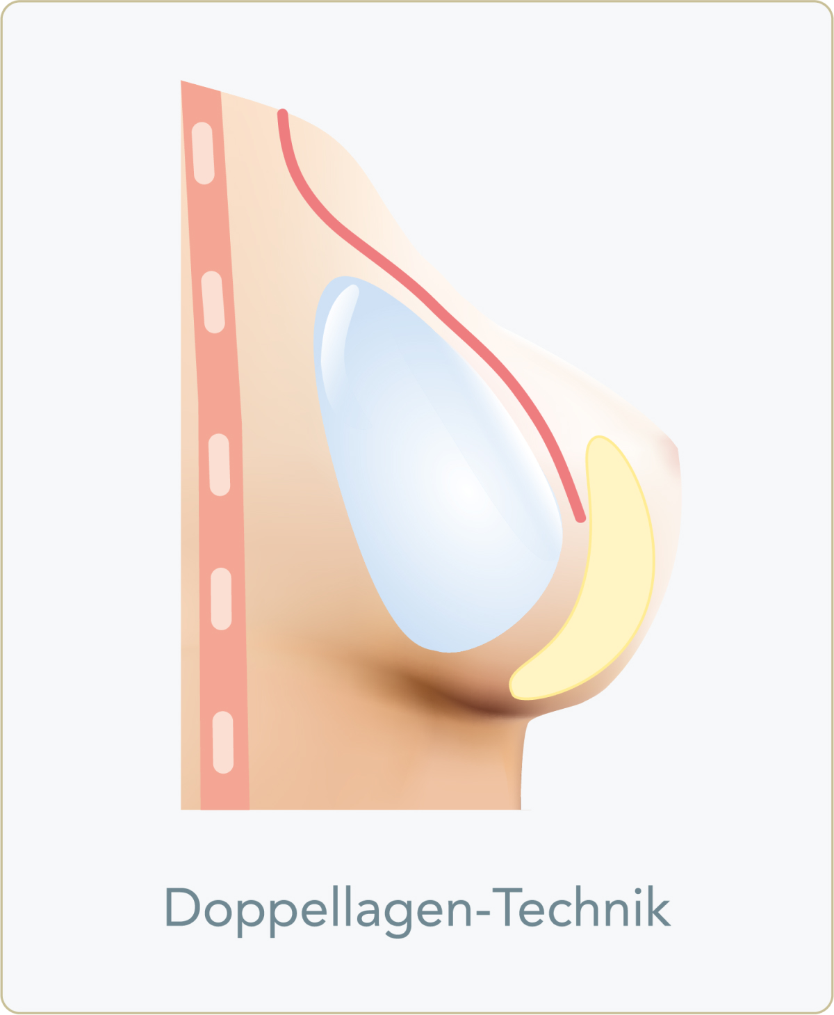 Submuskuläre (subpektorale) Implantation - Doppellagen Technik