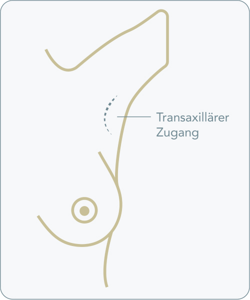 Transaxillärer Zugang - Wie läuft die Brustvergrößerung mit dem transaxillären Zugang ab?