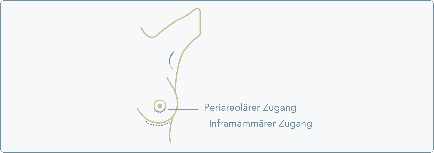 Transaxillärer Zugang - Welche Schnittführungen gibt es neben dem axillären Zugang?