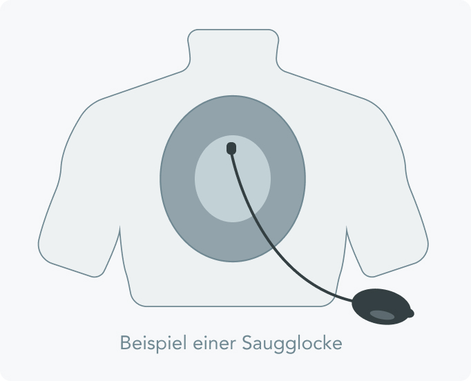Trichterbrust - Wie erfolgt die Behandlung der Trichterbrust mittels Saugglocke?