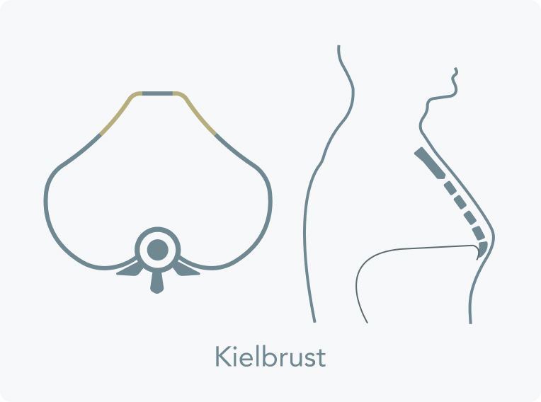 Trichterbrust - Was ist der Unterschied zwischen einer Trichterbrust und einer Kielbrust?