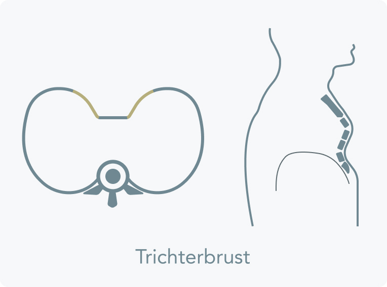 Trichterbrust - Was ist eine Trichterbrust?
