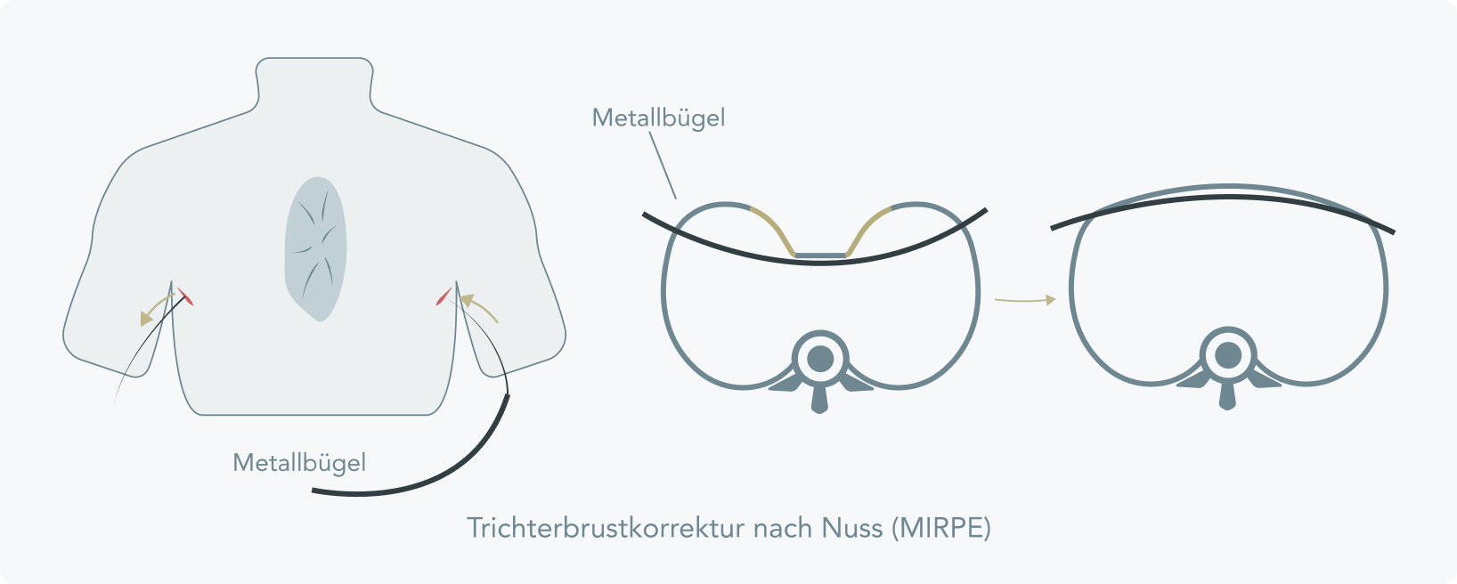 Trichterbrust - Wie läuft die Trichterbrustkorrektur nach Nuss (MIRPE) ab?