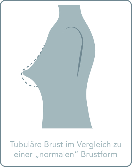 Tubuläre Brust - Was ist eine Tubuläre Brust?