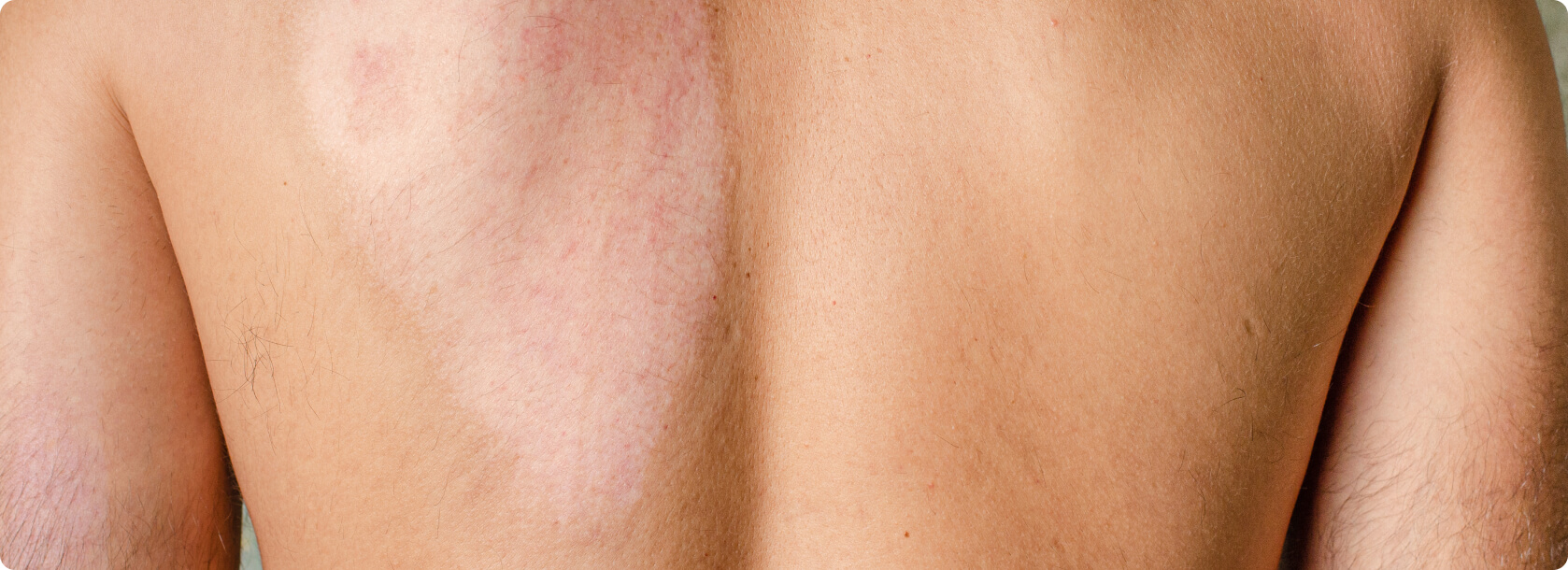 Hauttransplantation - Was passiert bei einer Vollhauttransplantation?