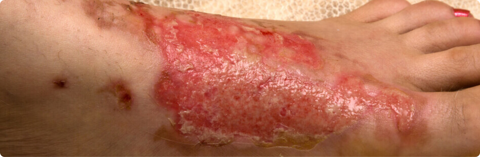 Hauttransplantation - Was versteht die Medizin unter einer Hauttransplantation?