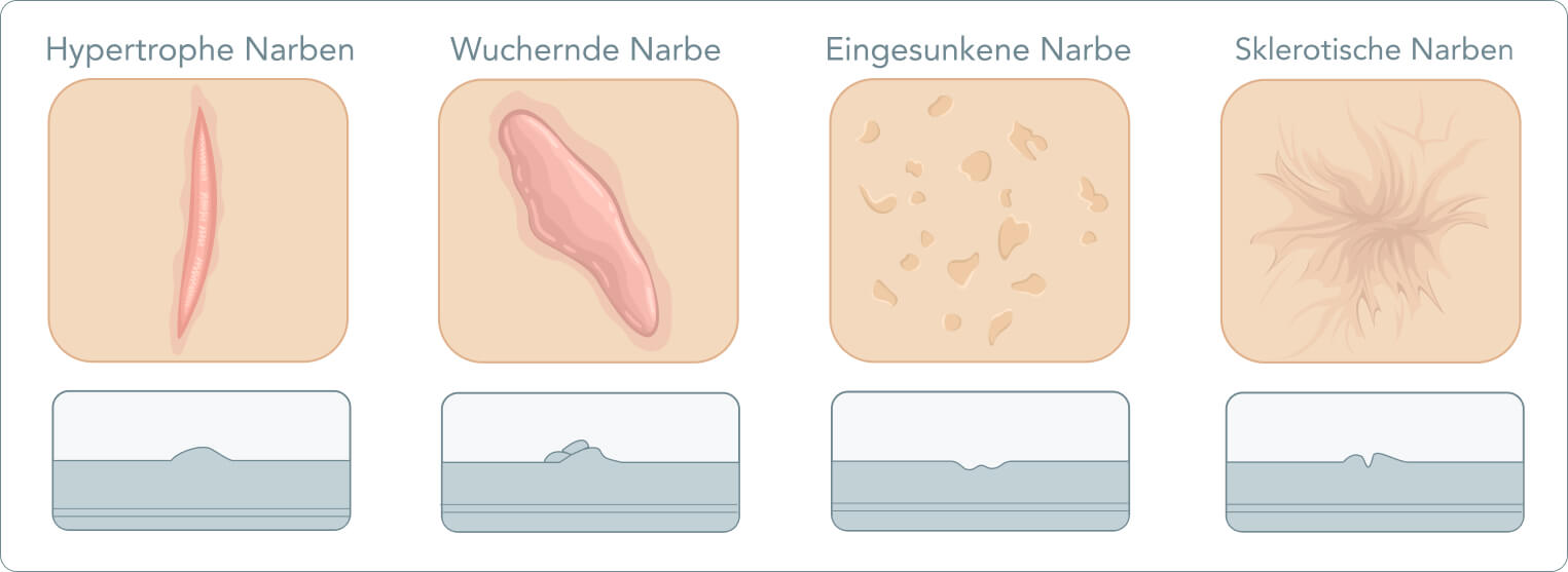 Narbenbehandlung/Narbenkorrektur - Welche Arten von Narben gibt es?