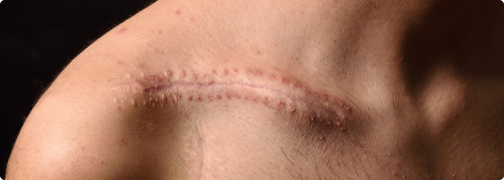 Narbenbehandlung/Narbenkorrektur - Was passiert vor der Behandlung meiner Narbe?
