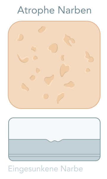Narbenpflege - Was sind hypotrophe/atrophe Narben?
