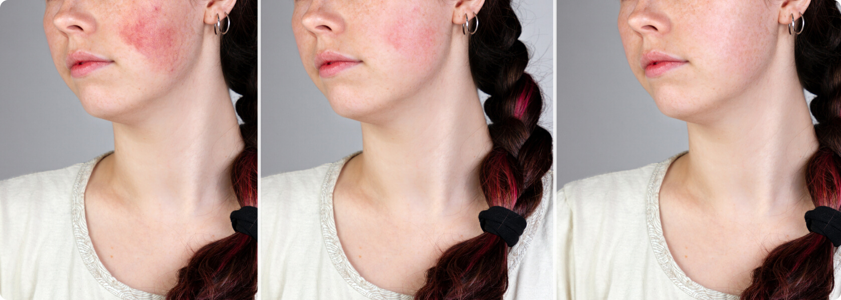 Rosacea - Was ist der Unterschied zwischen Rosacea und Couperose?