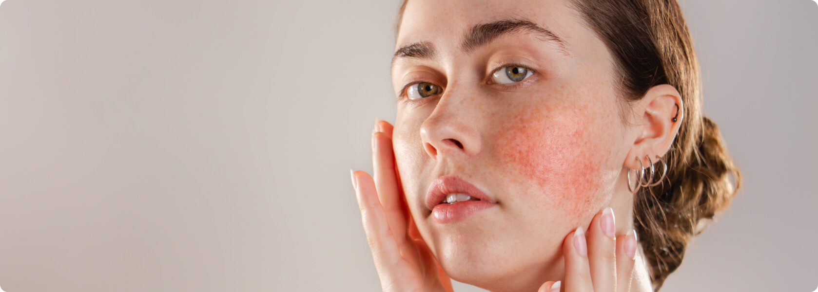 Rosacea - Was versteht die Medizin unter Rosacea?
