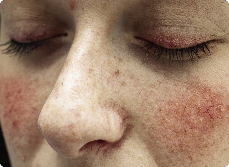 Rosacea - Was ist ein Rosacea-Schub und wie lange dauert er?
