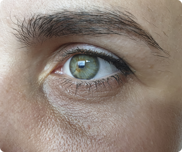 Behandlung der Tränenrinne mit Hyaluron - Was versteht die Medizin unter einer Tränenrinne?