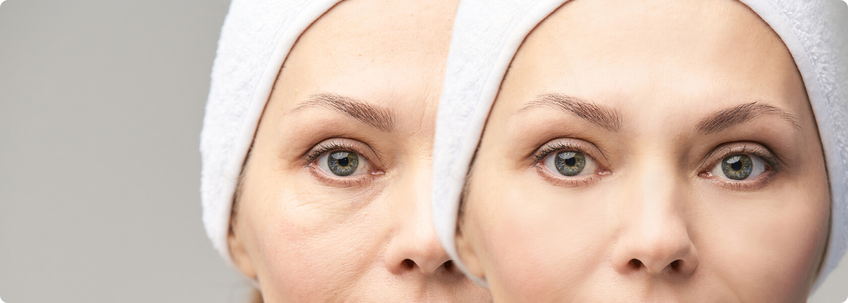 Behandlung der Tränenrinne mit Hyaluron - Welche Filler können bei der Tränenrinne zum Einsatz kommen?
