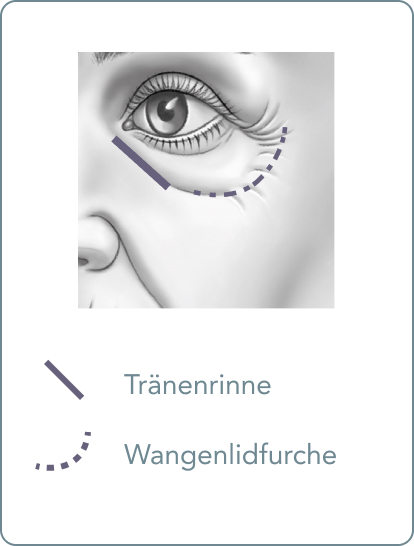 Behandlung der Tränenrinne mit Hyaluron - behandlung-traenenrinne-mit-hyaluron-wo-befindet-sich.jpg