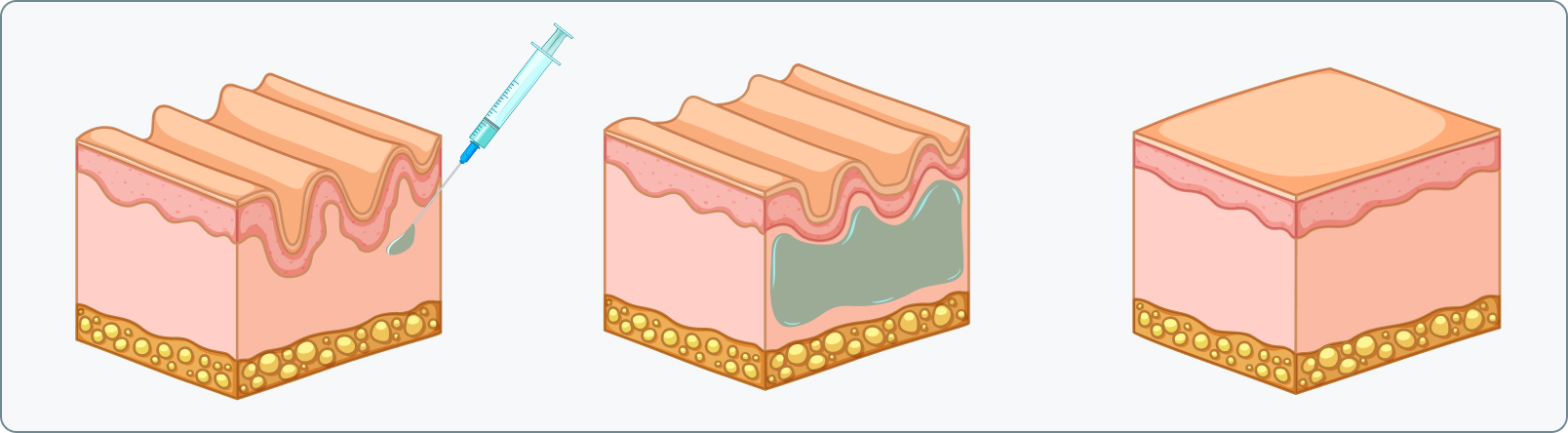 Botulinumtoxin (Botox©) - Wie läuft eine Faltenunterspritzung mit Botox© ab?