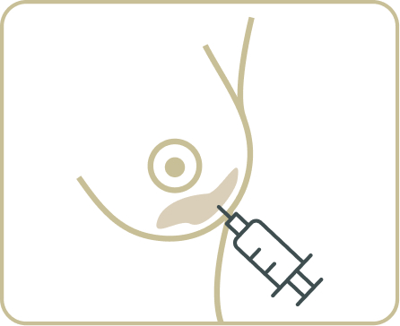 Lipofilling – Eigenfettunterspritzung - Für welche Bereiche ist Lipofilling geeignet?