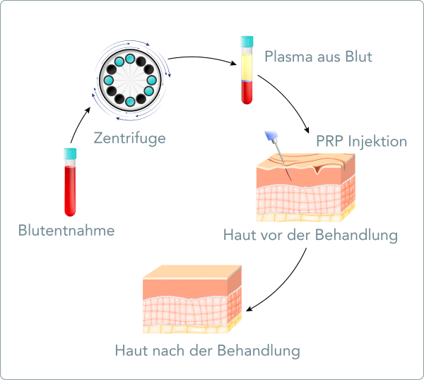 PRP-Behandlung (Vampir Lifting) - Wie verläuft die PRP-Methode?