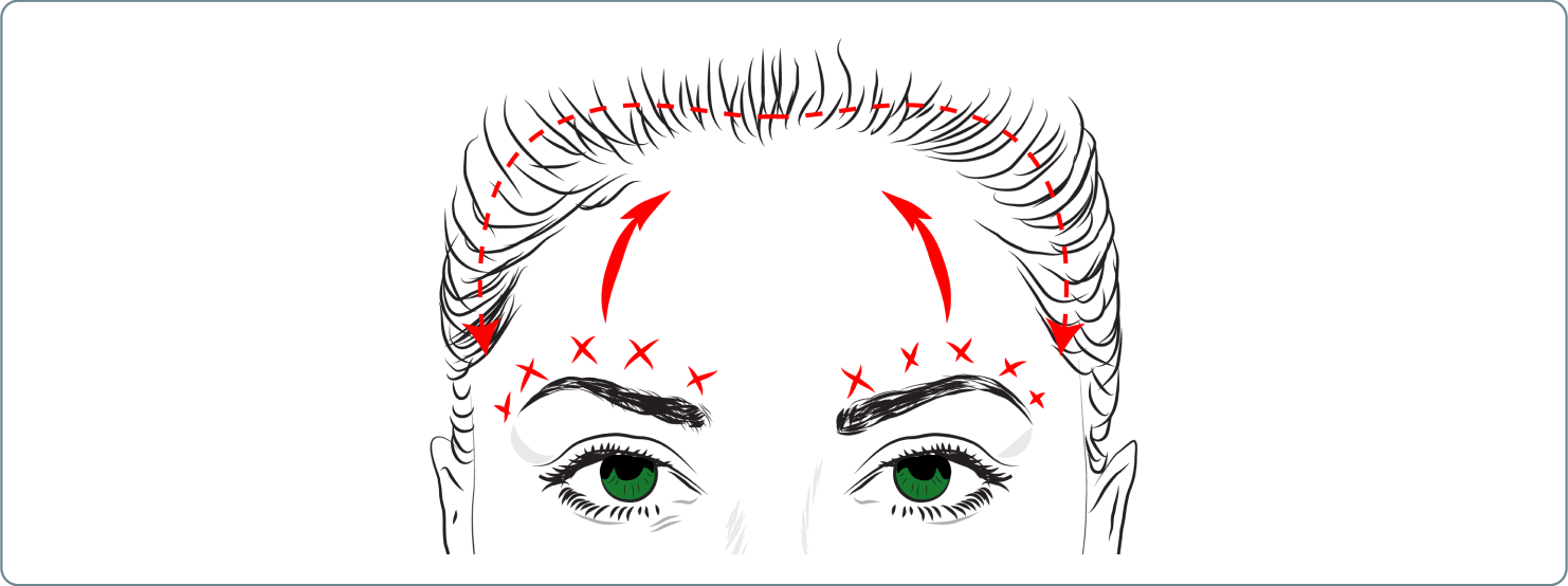 Augenbrauenlifting - Augenbrauenlifting mit Stirnlifting