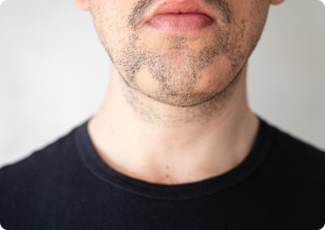 Barthaartransplantation - Was versteht die Medizin unter einer Barthaartransplantation?