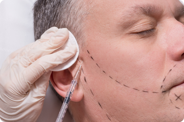 Barthaartransplantation - Wie läuft eine Barthaartransplantation ab?