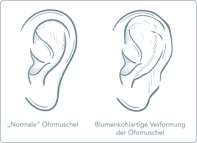 Blumenkohlohr - Was sind die Ursachen?