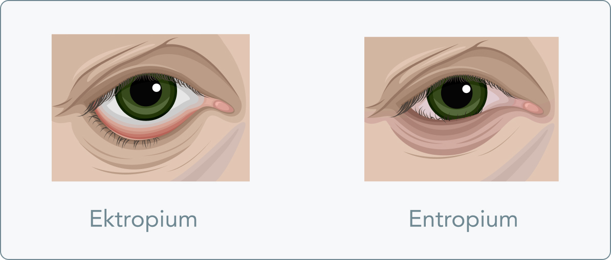 Ektropium - Was ist der Unterschied zwischen einem Ektropium und einem Entropium?