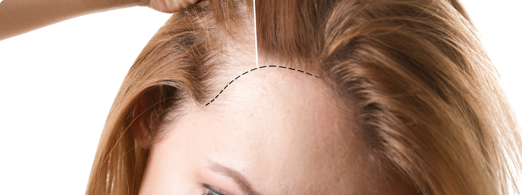 Haartransplantation - Was sind die Vor- und Nachteile der FUE-Methode?
