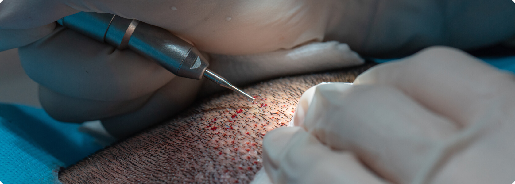 Haartransplantation - Wie läuft eine Haartransplantation ab?