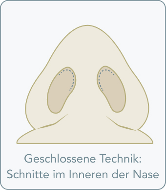 Hakennase - Geschlossene Technik