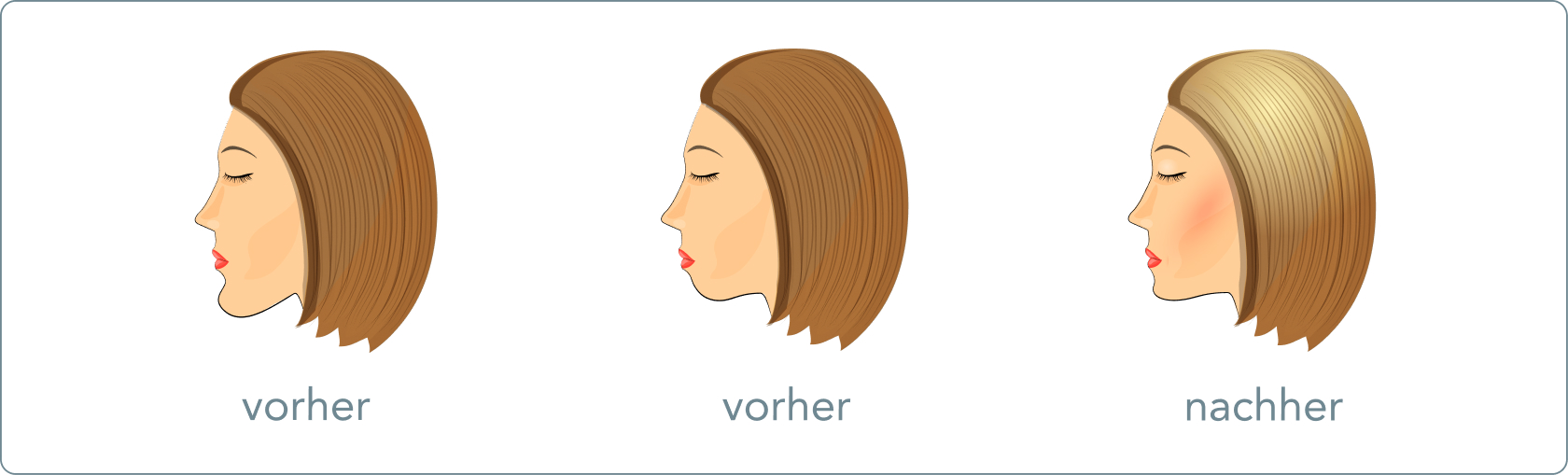 Kinnkorrektur (Genioplastik) – Welche Arten der Kinnkorrektur gibt es?