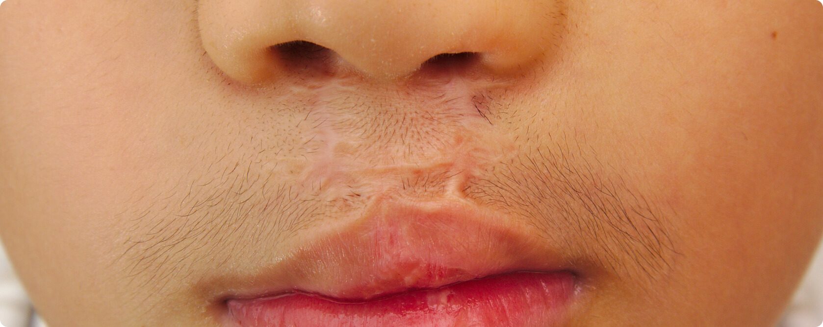 Lippen-Kiefer-Gaumenspalte (LKGS, Hasenscharte) - äußere und innere Nase im Laufe des Wachstums asymmetrisch entwickeln
