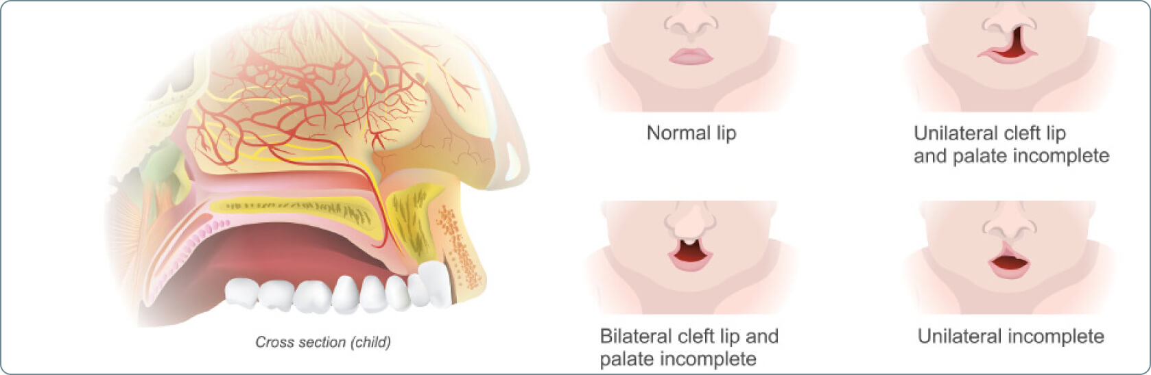 Lippen-Kiefer-Gaumenspalte (LKGS, Hasenscharte) - Welche Spaltenformen gibt es?