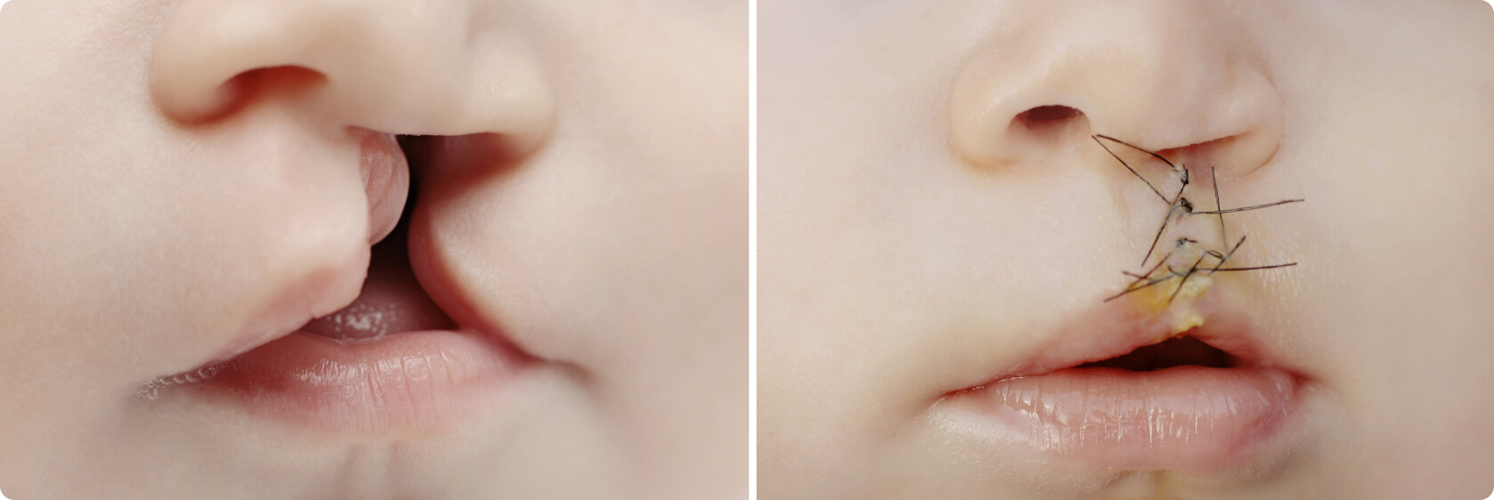 Lippen-Kiefer-Gaumenspalte (LKGS, Hasenscharte) - Wie verläuft die OP der Lippen-Kiefer-Gaumenspalte?