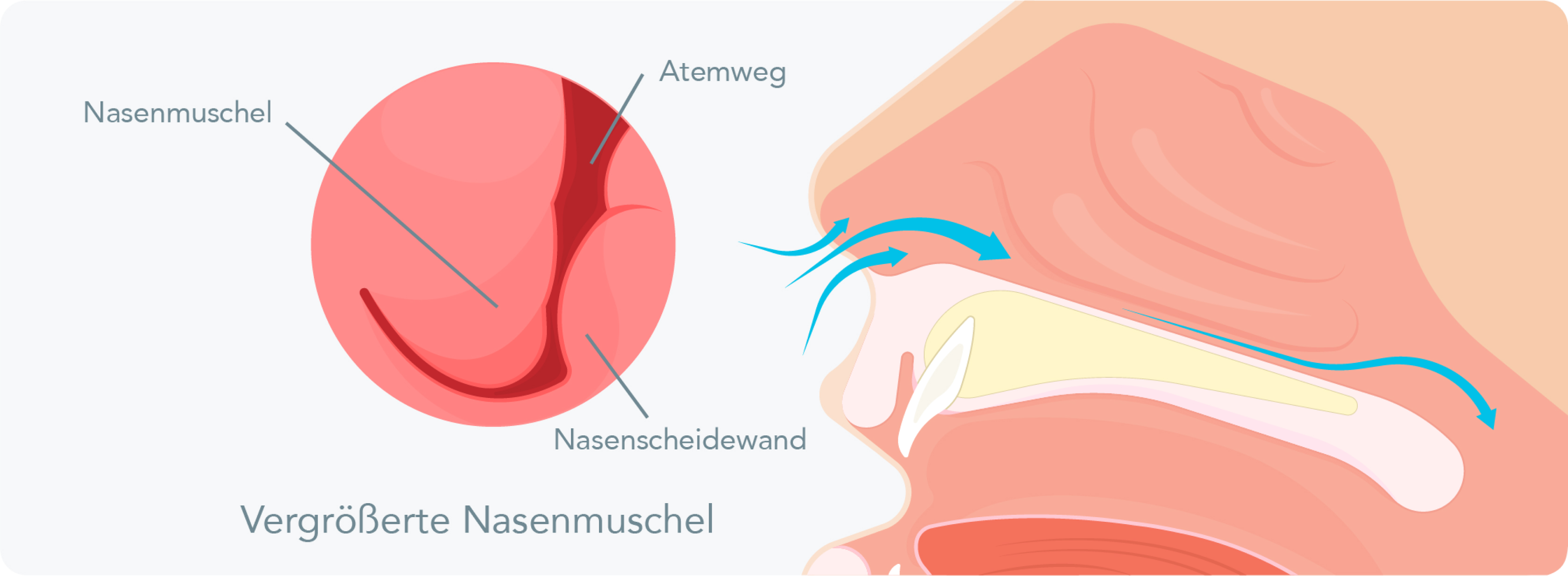Nasenmuschelhyperplasie - Wie läuft eine Conchotomie ab?