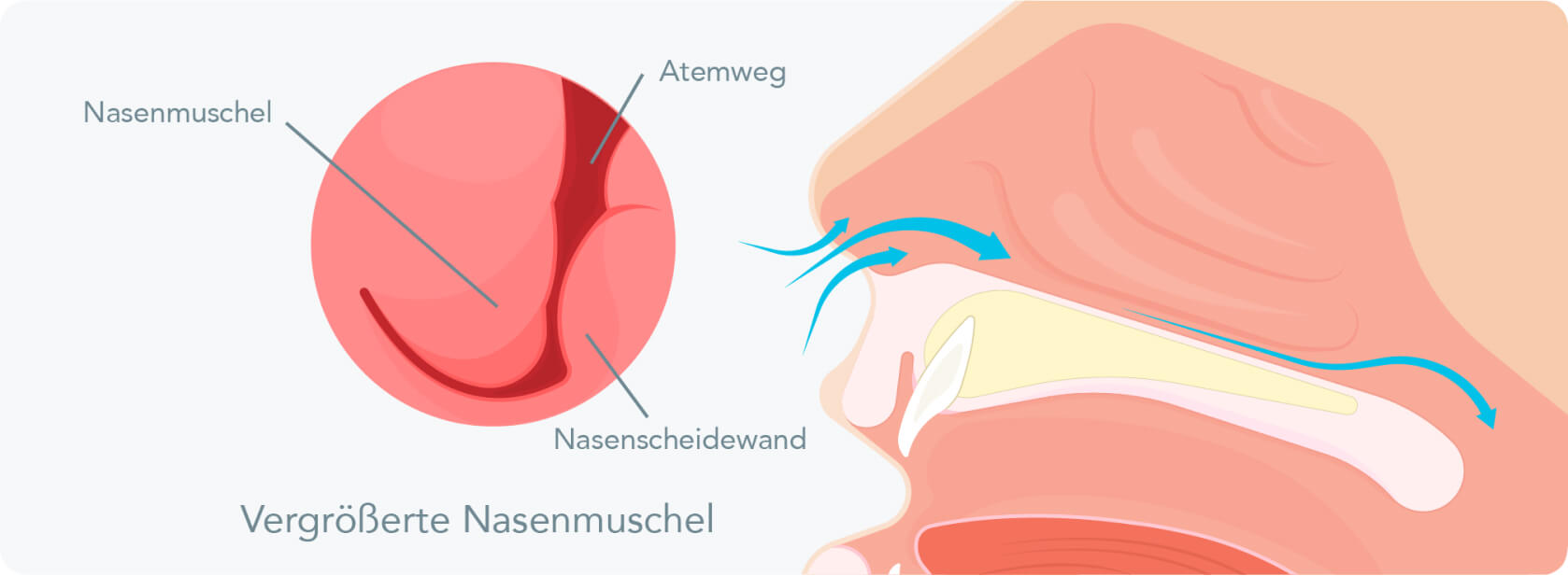 Nasenmuschelverkleinerung - Was sind die Gründe für eine Nasenmuschelverkleinerung?