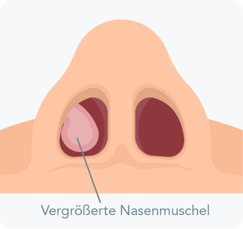 Nasenmuschelverkleinerung - Was ist eine Nasenmuschelhyperplasie?