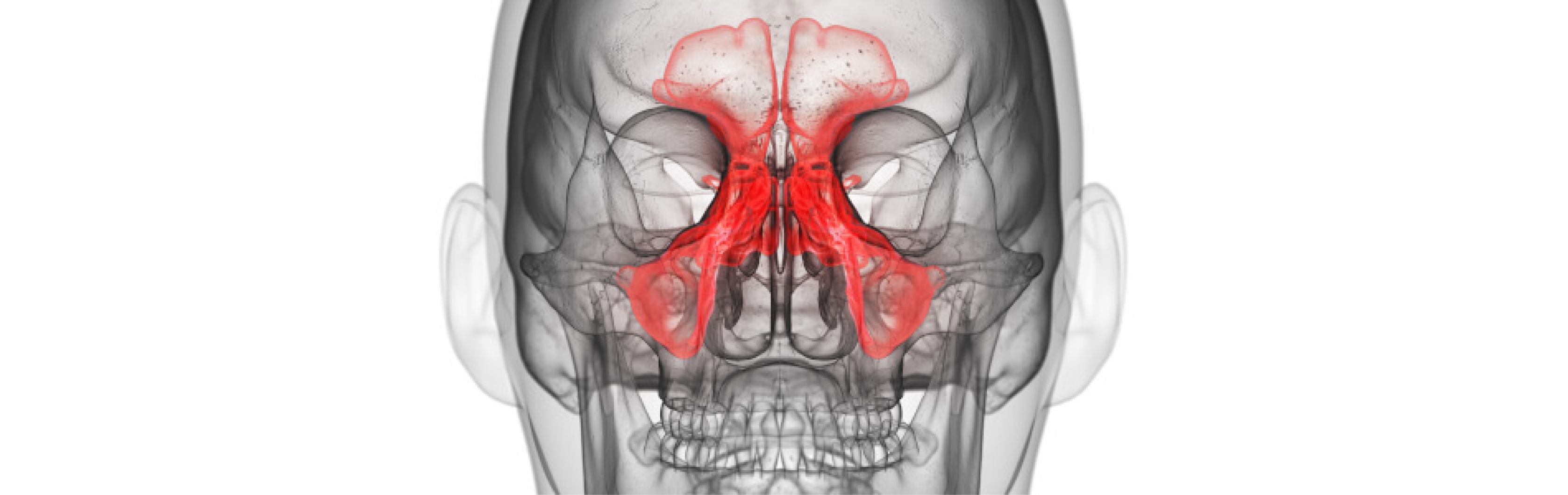 Nasennebenhöhlenentzündung (Sinusitis) - Kopfschmerzen
